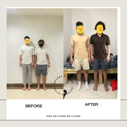 Kết quả Before After kéo dài chân Dr Lượng
